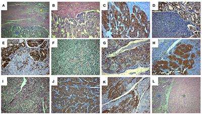 Uterine collision tumor (PEComa and endometrioid carcinoma) in a tuberous sclerosis patient: a case report